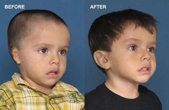 image of child before and after ear reconstruction