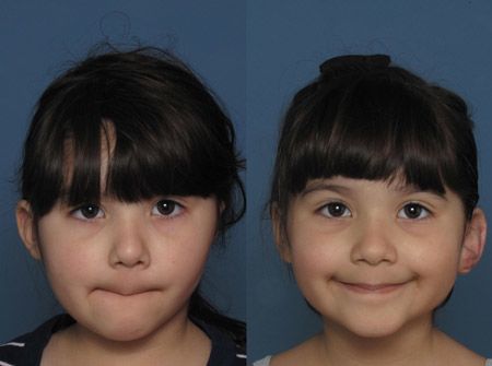 Hemifacial Microsomia before and after