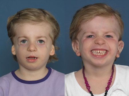 Treacher Collins Syndrome before and after