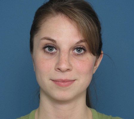 girl FRONT VIEW OF A RIB CARTILAGE EAR RECONSTRUCTION