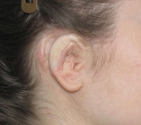 Lateral view of a Rib Cartilage Ear Reconstruction