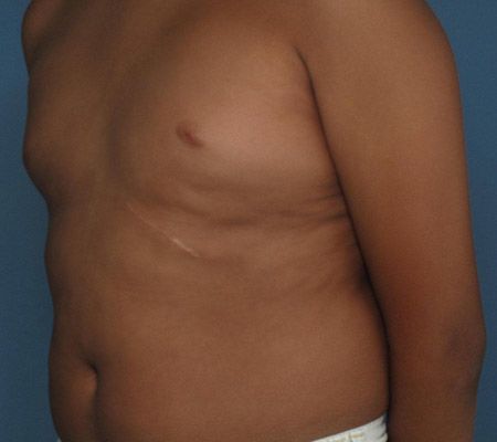 Chest Scar from Rib Harvest